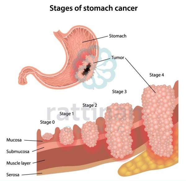 อาการมะเร็งกระเพาะอาหาร รักษายังไง